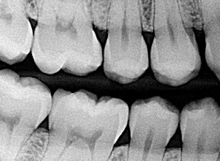 bitewing x-ray photograph