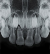 maxillary occlusal photo