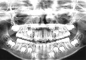 Panoramic x-ray